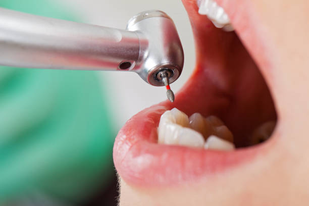 Best Emergency Root Canal Treatment in Montague, CA